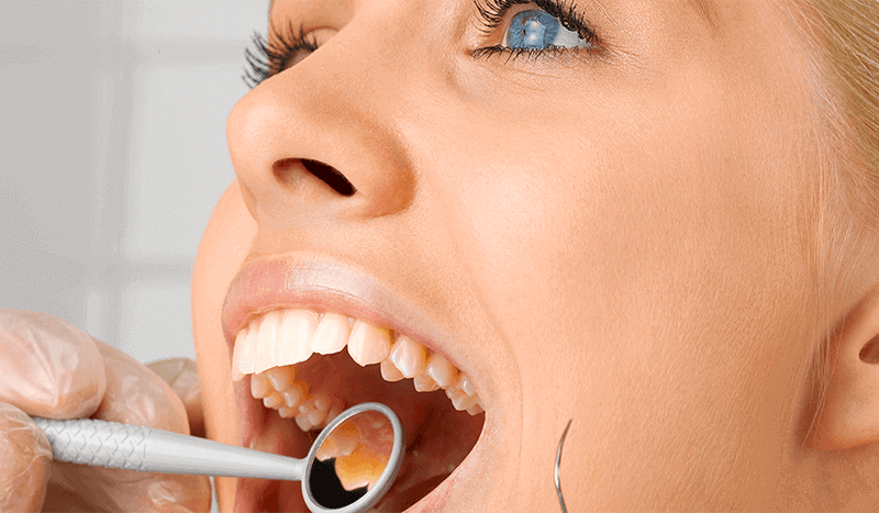 Zubní eroze: Příznaky, příčiny a léčba